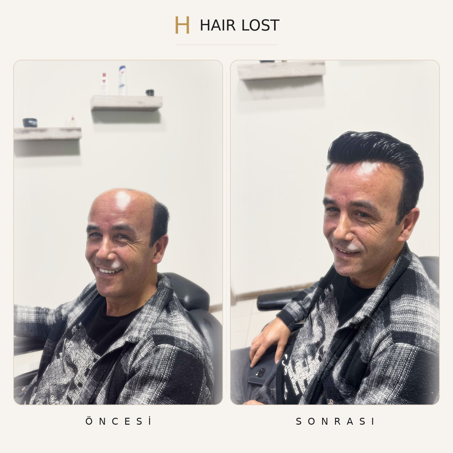 Protez saç öncesi ve sonrası üç çeyrek açı, doğal saç çizgisi — Hair Lost Antalya