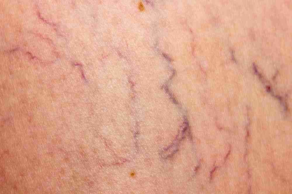 Épilation et traitement des varicosités des jambes