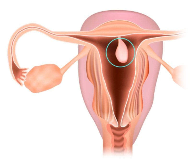 Pólipo endometrial - diagnóstico e tratamento