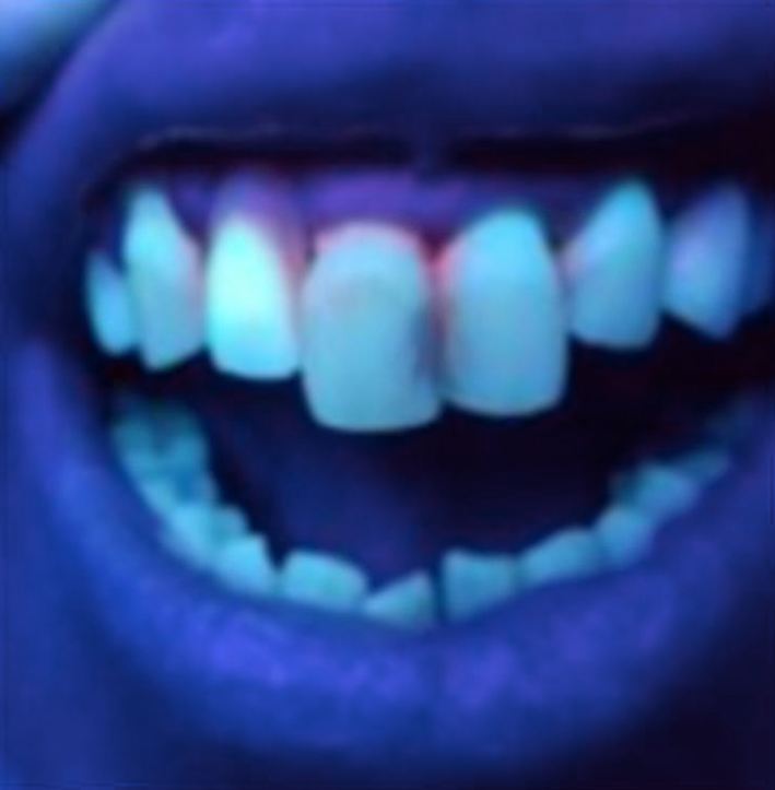 Collet des dents sous UV