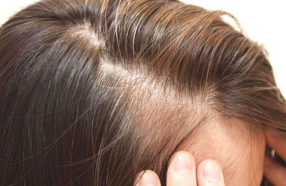 Hormonális hajhullás szemléltetése