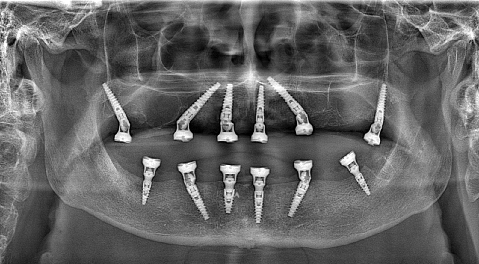 Röntgenbeeld van tandheelkundige implantaten