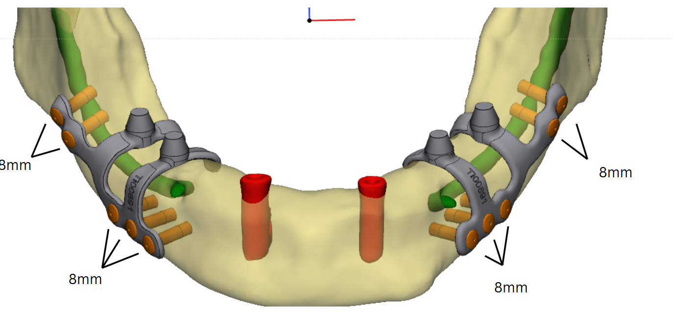 3D digitale planning van implantaten in de kaak