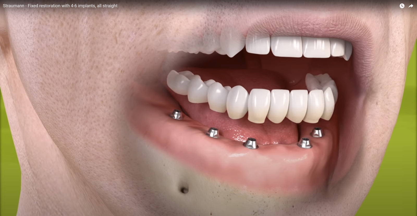 Vaste brug op de implantaten