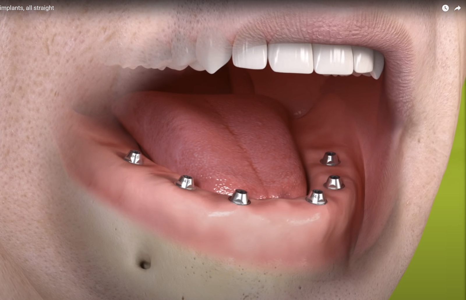 Multi-unit abutments op de implantaten