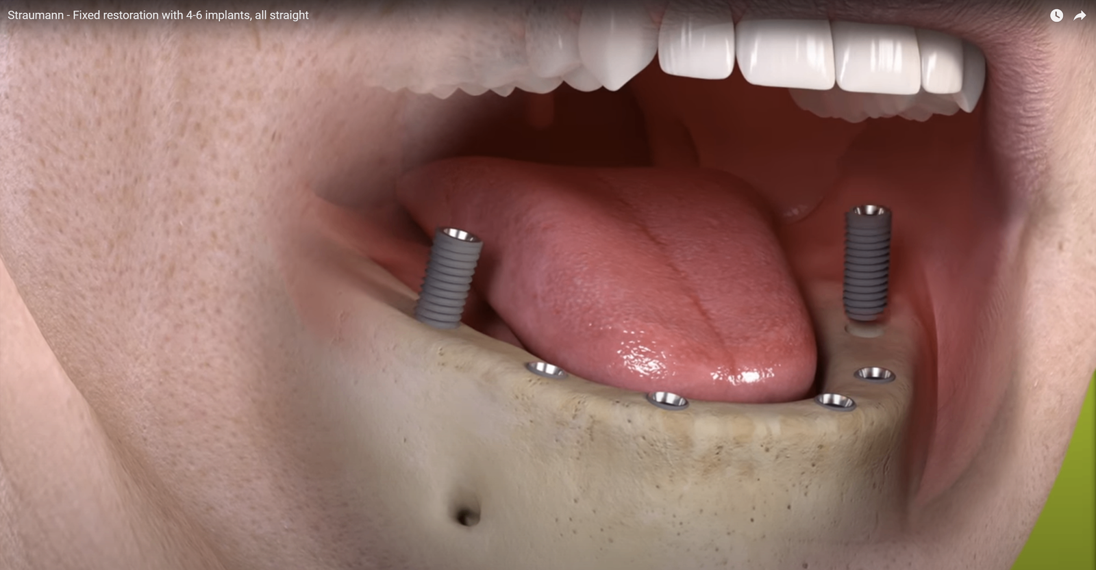 Geplaatste implantaten in de onderkaak