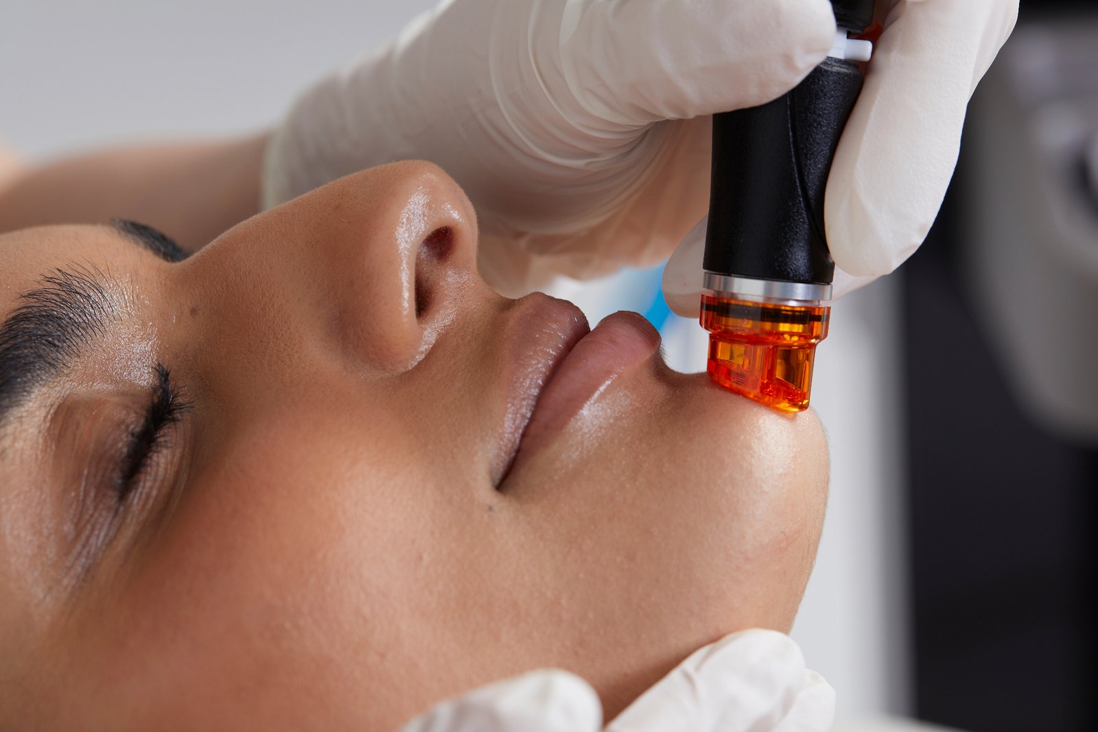 HydraFacial-Behandlung mit dem HydraFacial-Gerät