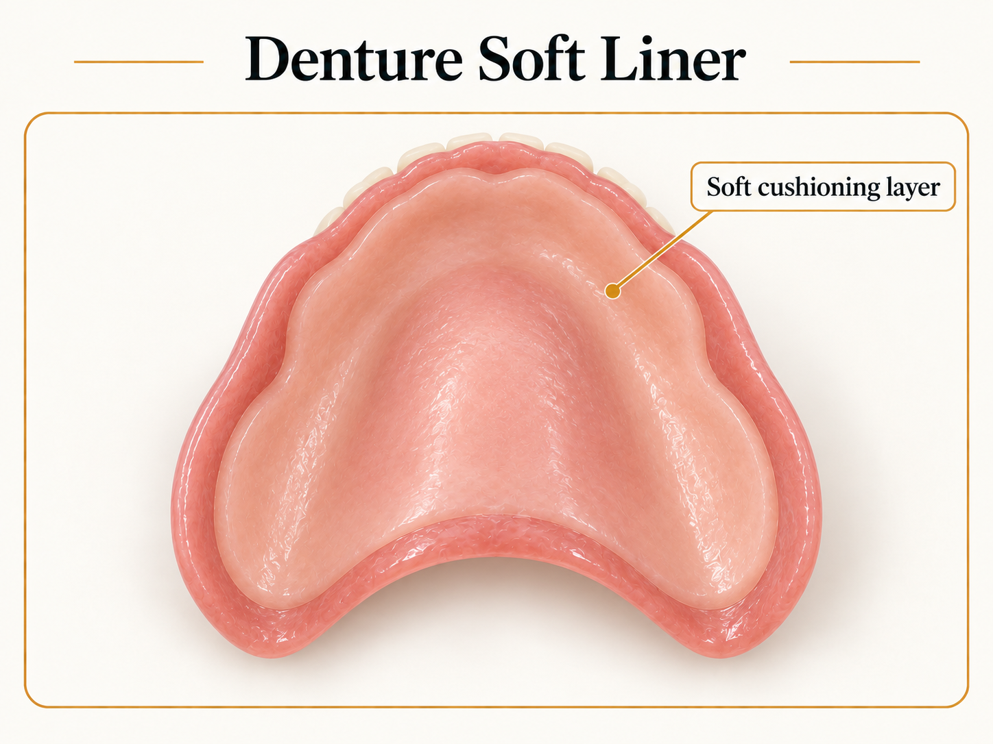 The interior fitting surface of a denture showing a smooth soft pink cushioned liner