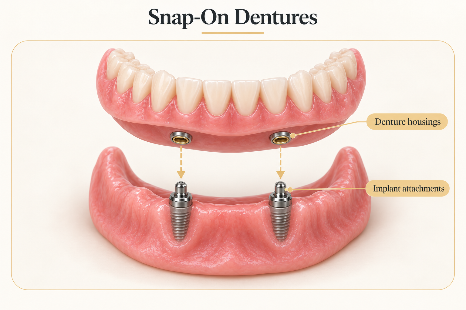 A denture pressing onto round implant stud attachments with a visible snap fit on a clinical tray
